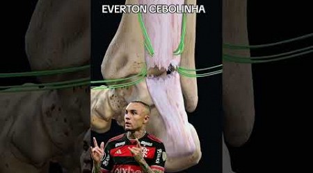 detalhe cirugia everton cebolinha !