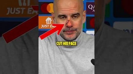 Pep Guardiola cut his nose after getting cooked for the sixth time in a row. 